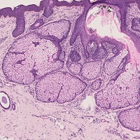 脂腺母斑
